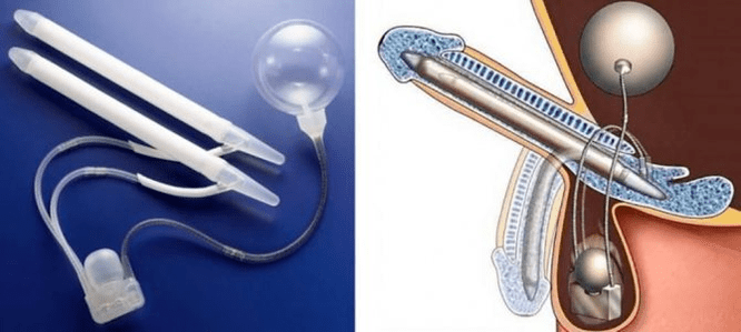 phaloprosthetics for penis enlargement