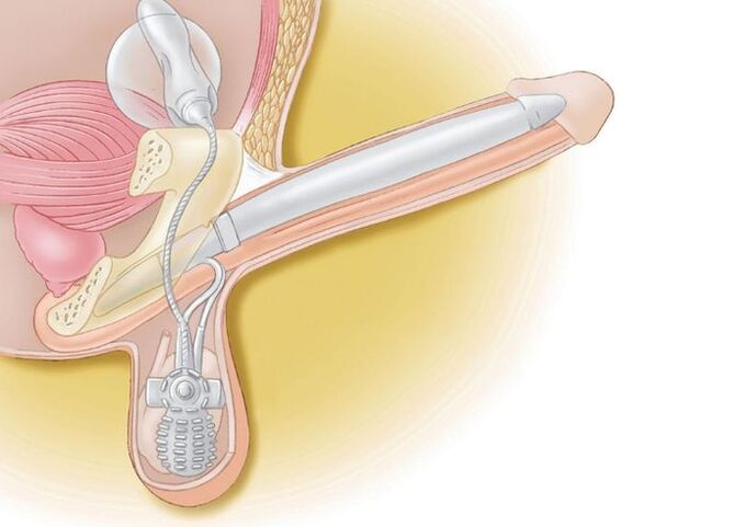 penile prosthetics for enlargement
